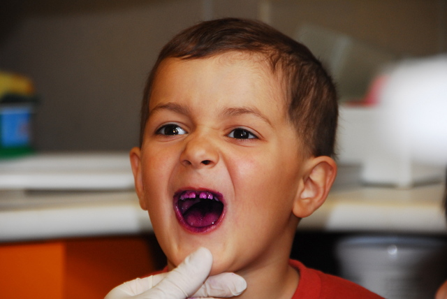 Ovodások a fogorvosnál 2 - a cukorka megszinezi azt a fogat ami nincs jól megmosva